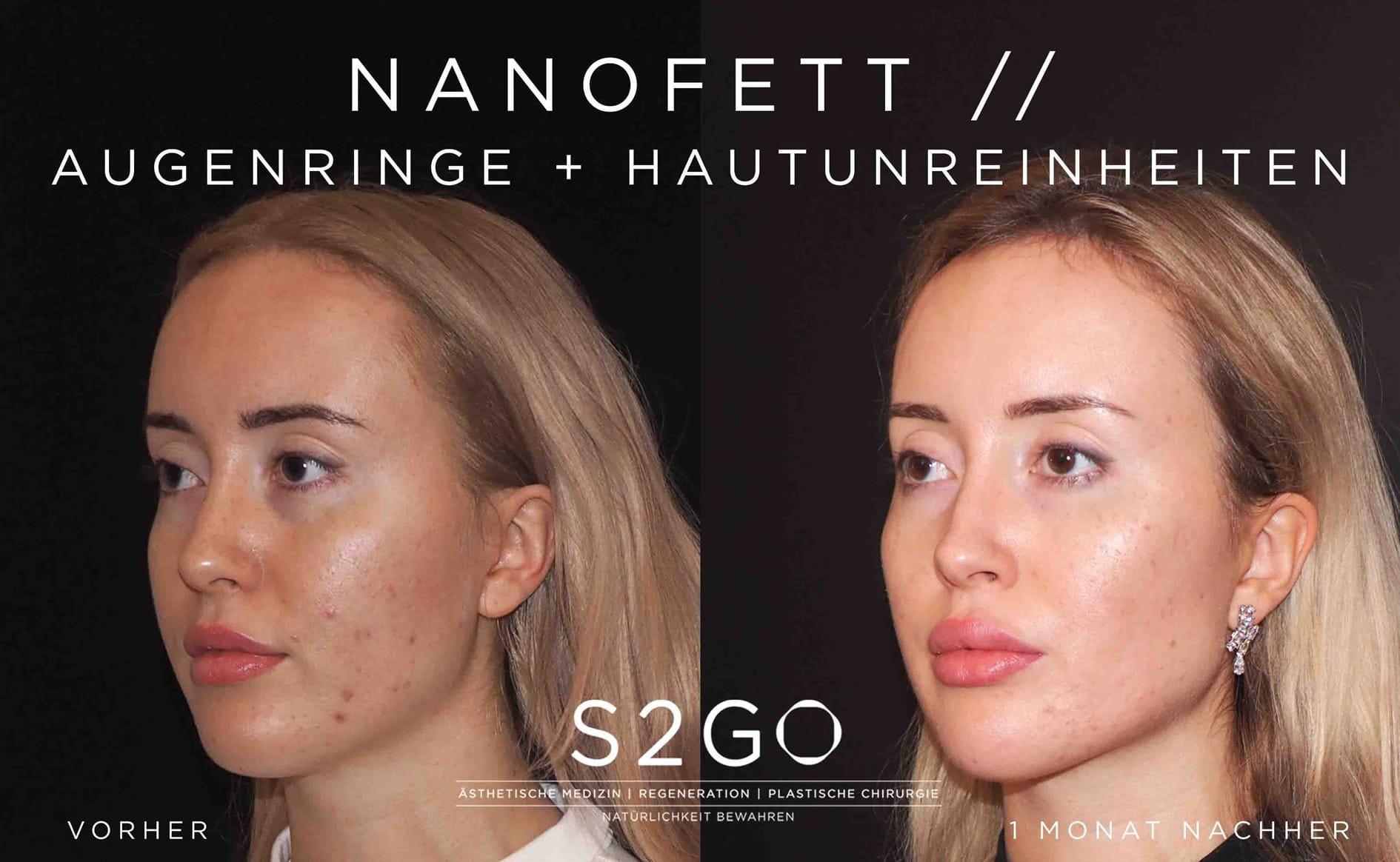 Patientientin Nanofett nach 1 Monat