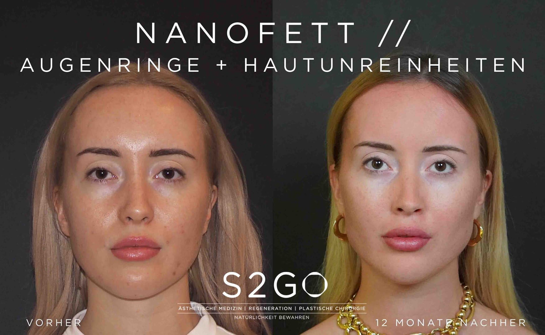 Patientin behandelt mit Nanofett nach 12 Monaten im Profil