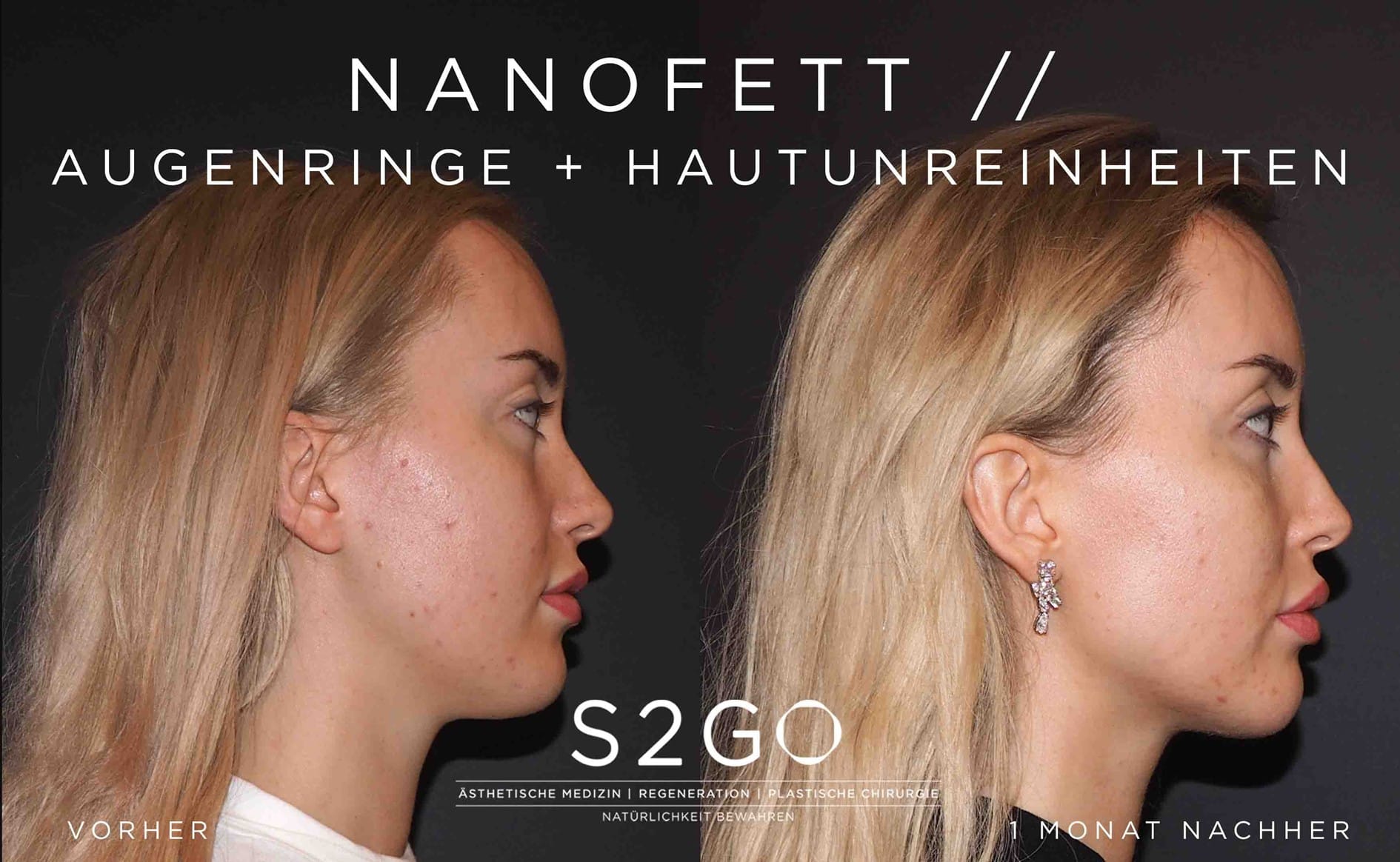 Patientin behandelt mit Nanofett nach 6 Monaten im Profil