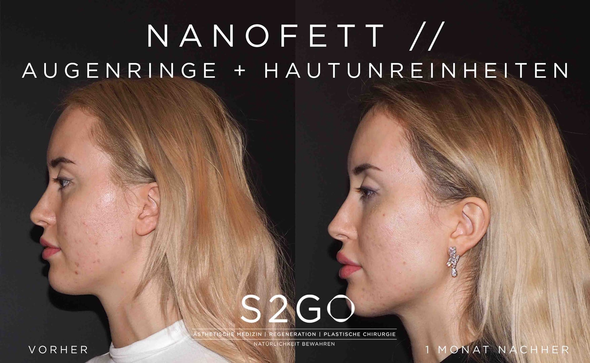 Patientin behandelt mit Nanofett nach 6 Monaten im Profil