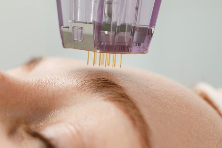 Stirn wird mit Nadeln gestochen für Microneedling