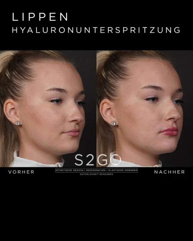 Dezente Veränderungen können einen großen Unterschied machen.

Durch eine sanfte Lippenunterspritzung mit Hyaluronsäure wurde die natürliche Form leicht definiert und die Lippen harmonisch betont – ohne den individuellen Charakter zu verändern.

Unser Ziel: natürliche Ergebnisse, die zum Gesicht passen. 🤍

#lippenunterspritzung #hyaluronlippen #naturalergebnisse #ästhetischemedizin #vorhernachher