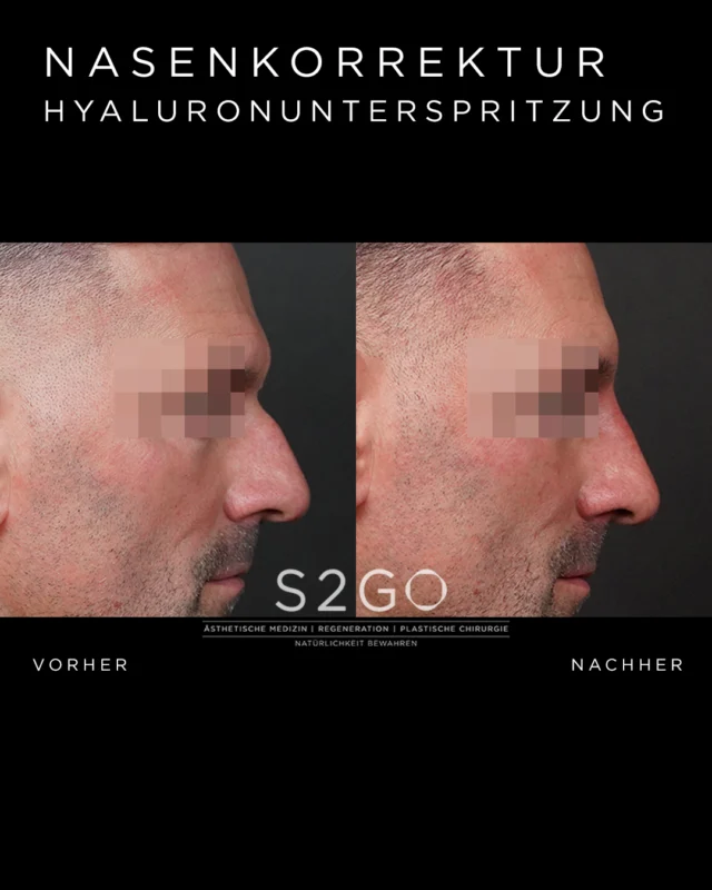 Nicht verändern – sondern ausgleichen.

Durch gezielte Hyaluronbehandlung kann die Nase optisch begradigt und harmonisiert werden – subtil, präzise und individuell abgestimmt.

#nasenkorrekturohneop #hyaluron #ästhetischemedizin #gesichtsharmonie #vorhernachher #naturallook