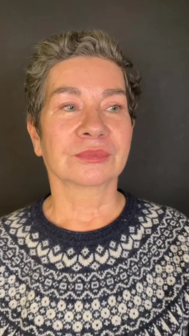 3 Wochen nach Deep Plane & Facelift.
Ein erstes Zwischenergebnis – das finale Resultat zeigt sich nach vollständiger Heilung. 

#deepplanefacelift #plastischechirurgie #plasticsurgery #vienna