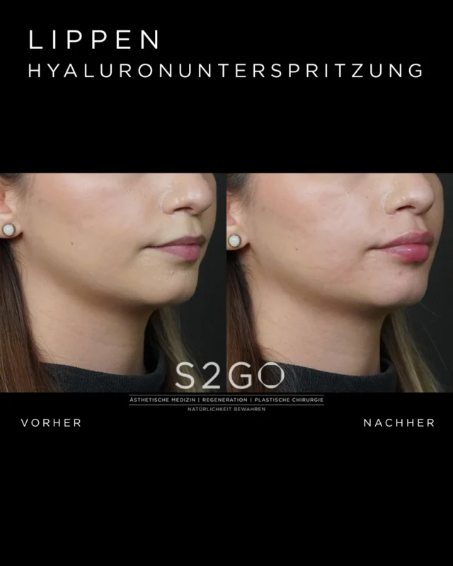 Natürlichkeit steht immer im Fokus.

Durch eine gezielte Lippenunterspritzung mit Hyaluronsäure wurden Form und Kontur sanft harmonisiert – abgestimmt auf die individuelle Gesichtsform unserer Patientin.

Das Ziel: natürliche, ausgewogene Lippen, die das Gesicht ergänzen und nicht verändern 🤍

#lippenunterspritzung #hyaluronlippen #naturalergebnisse #ästhetischemedizin #vorhernachher #naturallips #gesichtsharmonie #wenigeristmehr