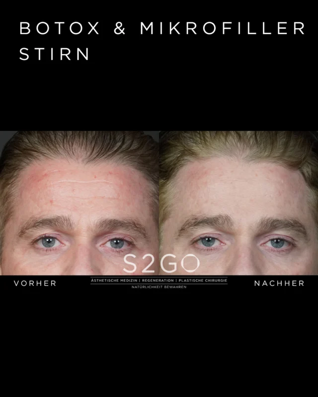 Botox Vorher/Nachher 

Immer mehr Männer entscheiden sich für dezente Behandlungen, um Falten in der Stirn- und Augenpartie zu glätten. 

Was viele nicht wissen:
Männerhaut ist bis zu 20 % dicker, produziert mehr Talg und hat eine stärkere Muskulatur. Daher kommen Falten oft später, sind dafür aber deutlich tiefer. 

Genau hier setzt Botox an:
Die Muskulatur wird entspannt und die Haut kann sich glätten.

Das Ziel:
Natürlich. Maskulin. Unauffällig.

📩 Jetzt Termin sichern: 
DM | Online | Telefon | E-Mail | Vor Ort

#botox #vorhernachher #stirnfalten #botoxformen #wienbeauty #antiagingformen #ästhetischemedizin #freshlook
