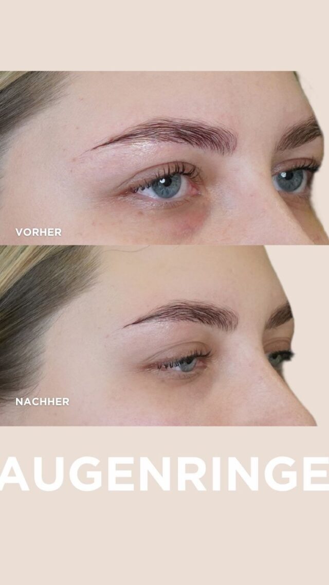 Wusstest du schon, dass man Augenringe mit Hyaluronsäure unterspritzen kann? Das Treatment polstert deine Under Eye Area wieder auf und lässt dunkle Schatten verschwinden!✨
.
.
.

#plastischechirurgie #plasticsurgery #beauty #vienna #plasticsurgeryclinic #drliebmann#loveyourself #botoxfacial #botoxfiller #botoxinjections #dermalfiller #babybotox #mesobotox #feelgood #happy #oberschenkelstraffung  #love #dermalfiller #babybotox #mesobotox #feelgood #brustvergrößerung  #brustvergrößerung  #breastaugmentation #breastimplants#schönheit2go #vienna #wien #donauzentrum #nasenkorrektur #undereyefiller #undereyebags