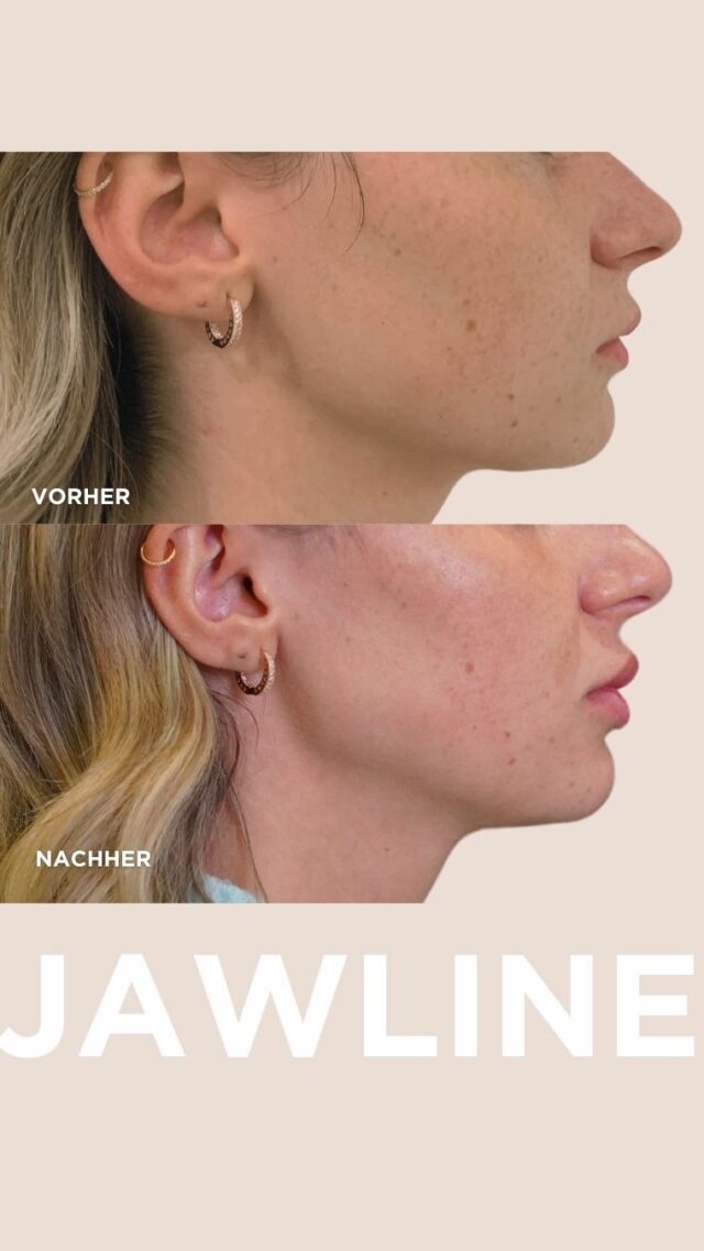 Die Jawline, auch bekannt als Kieferlinie, spielt eine entscheidende Rolle für die Definition und Symmetrie unseres Gesichts. Durch die gezielte Anwendung von Hyaluron können wir die Konturen unserer Jawline verbessern und einen harmonischen Übergang zum Hals schaffen. 💎💫

Vereinbare deinen kostenlosen Beratungstermin via DM 💌 Lass uns gemeinsam an deiner natürlichen Schönheit arbeiten! 💫💕

#JawlineKonturierung #HyaluronBehandlung #Ästhetik #Schönheit #Gesichtsbehandlung #JugendlicheAusstrahlung #Selbstvertrauen #Eleganz #terminvereinbarung #schönheit2go #wien