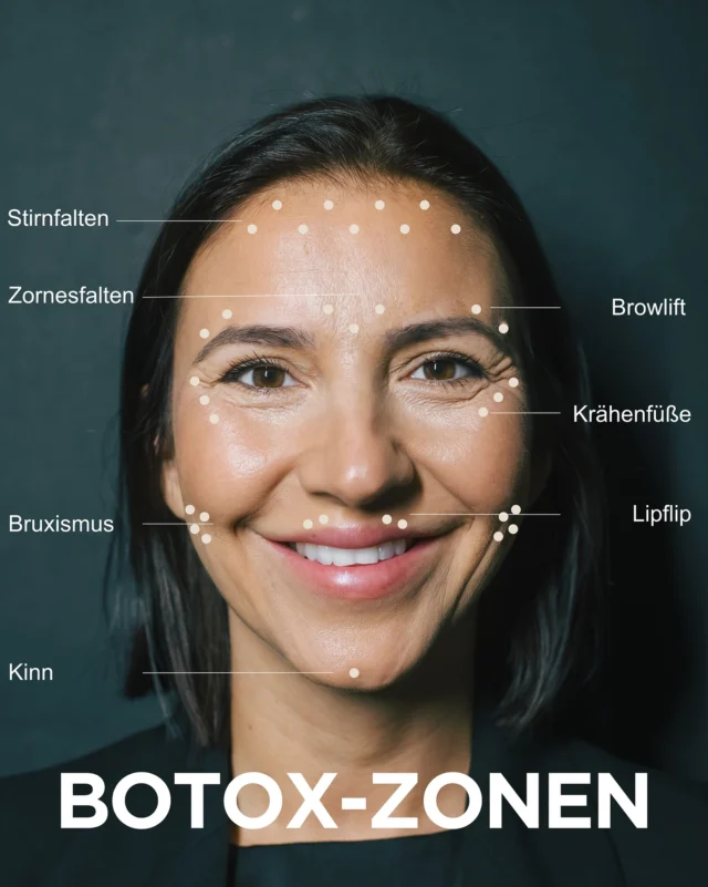 Botox-Punkte: Präzision macht den Unterschied. ✨

Jeder Behandlungspunkt wird individuell auf Anatomie, Muskelaktivität und gewünschtes Ergebnis abgestimmt. 

Ob Stirn, Zornesfalte oder Krähenfüße – es geht nicht darum, möglichst viele Punkte zu setzen, sondern gezielt und harmonisch zu behandeln.

Das Ziel: ein frischer, entspannter Look und eine natürliche Mimik. 🤍

#BotoxWien #BotoxBehandlung #ÄsthetischeMedizin #Faltenbehandlung #schönheit2go