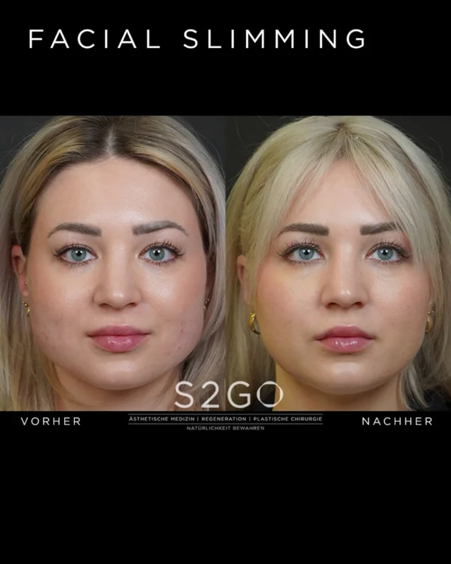 Mehr Kontur. Mehr Harmonie.

Durch gezielte Behandlung des Masseter-Muskels kann die untere Gesichtspartie sanft verschmälert und das Gesichtsprofil sichtbar verfeinert werden.

Das Ergebnis: ein schlankeres, harmonisches Erscheinungsbild – ganz ohne operative Eingriffe 🤍

#facialslimming #masseterbotox #gesichtskontur #ästhetischemedizin #vorhernachher