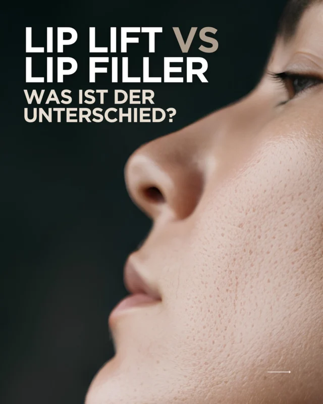 Lip Filler oder Lip Flip – was ist der Unterschied? 👄

Beide Behandlungen können die Lippen optisch verändern, funktionieren aber ganz unterschiedlich:

💉 Lip Filler: Hyaluronsäure sorgt für mehr Volumen, Definition und kann kleine Asymmetrien ausgleichen.

✨ Lip Flip: Botox entspannt gezielt den Muskel oberhalb der Oberlippe, sodass sich die Lippe leicht nach außen drehen und mehr Lippenrot sichtbar werden kann – ohne zusätzliches Volumen.

Welcher Effekt zu dir passt, hängt von deinen Lippen, deinen Proportionen und deinem gewünschten Ergebnis ab. 🤍 

AI generated content
#LipFiller #LipFlip #Lippenästhetik #BotoxWien #schönheit2go