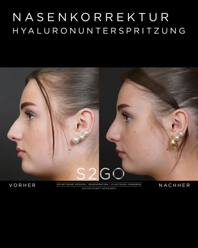 Mit einer minimalinvasiven Behandlung können bereits kleine Veränderungen große Wirkung erzielen.
Durch präzise Injektionen mit Hyaluronsäure lässt sich das Nasenprofil harmonisieren – ganz ohne Operation, mit sofort sichtbarem Ergebnis.

✔️ ambulant & nahezu schmerzfrei
✔️ sofort gesellschaftsfähig
✔️ natürliche Ergebnisse

Du möchtest wissen, ob eine Hyaluron-Nasenkorrektur für dich geeignet ist? Vereinbare gerne ein persönliches Beratungsgespräch.

Jetzt Termin sichern:
DM | Online | Telefon | E-Mail | Vor Ort