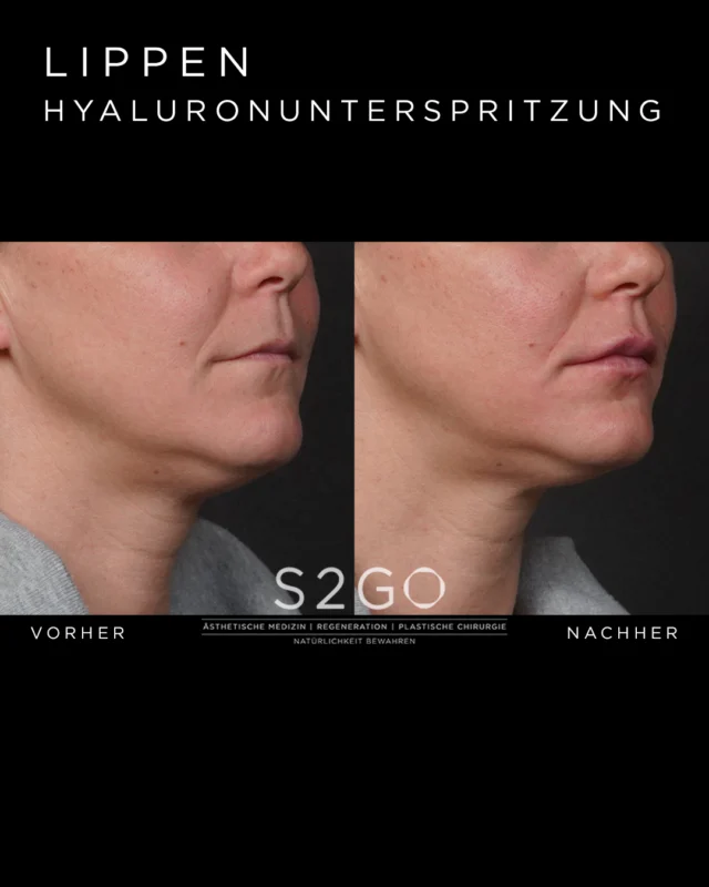 Weniger ist oft mehr.

Durch eine dezente Lippenbehandlung wurde die natürliche Form sanft definiert und die Lippen subtil betont – ohne den individuellen Ausdruck zu verändern.

Im Fokus steht bei uns immer ein Ergebnis, das harmonisch wirkt und zum Gesicht passt 🤍

#lippenbehandlung #naturallips #hyaluronlippen #ästhetischemedizin #vorhernachher #wenigeristmehr #gesichtsharmonie