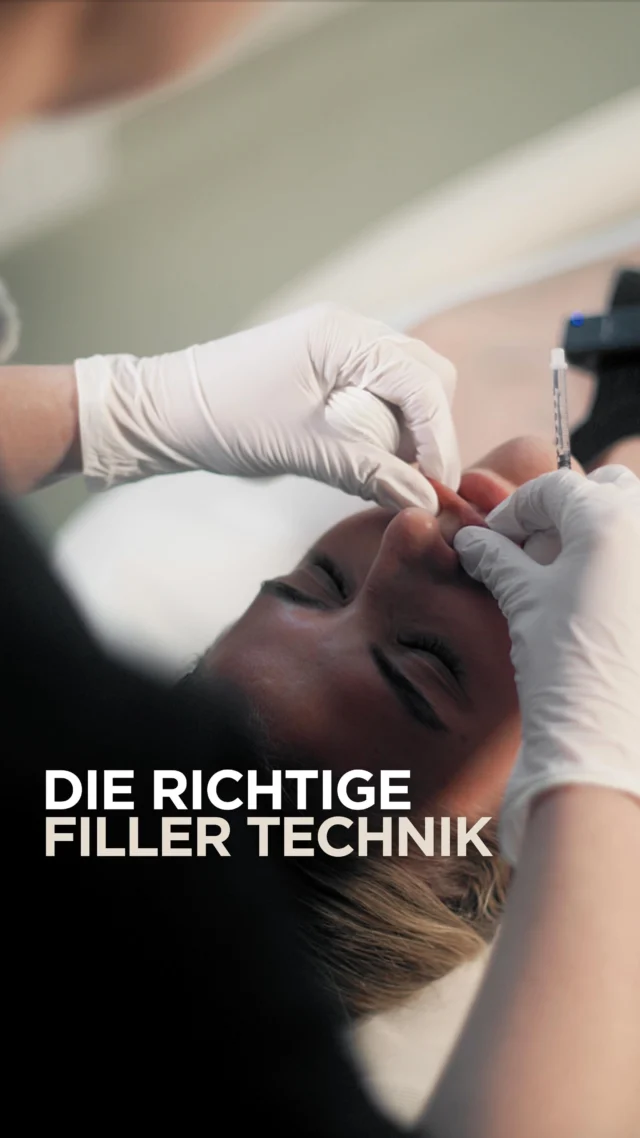 Natürliches Lippenvolumen entsteht nicht einfach durch „mehr Filler“. 💋✨

Bei Pia arbeiten wir mit einer vertikalen Technik, bei der sehr kleine Depots gezielt und gleichmäßig im Lippenkörper platziert werden.

Der Fokus liegt dabei auf ihrem natürlichen Lippenvolumen und ihrer bestehenden Form. Die Lippenkontur wird bewusst ausgespart, um die natürliche Grenze der Lippen zu erhalten. 🤍

Bei der Behandlung wird außerdem darauf geachtet, nicht unnötig viel Volumen einzubringen. Denn wie viel Hyaluronsäure sinnvoll ist, hängt immer von der individuellen Anatomie und dem vorhandenen Gewebe ab.

Nach der Behandlung zeigen wir außerdem, wie die Lippen zu Hause gepflegt und – falls empfohlen – sanft massiert werden können.

Das Ziel: mehr Fülle, ohne die natürliche Lippenform zu verlieren. ✨

#Lippenfiller #HyaluronFiller #NaturalLips #Lippenaufbau #Schönheit2go