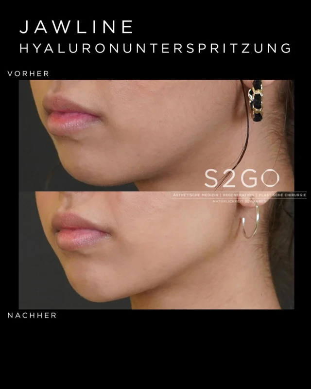 Subtile Veränderung. Sichtbare Definition.

Eine harmonische Jawline kann dem Gesicht mehr Struktur und Kontur verleihen – ohne unnatürlich zu wirken.

Natürliche Ergebnisse beginnen mit einer individuellen Analyse und einer präzisen Behandlung 🤍

#jawlinecontouring #jawlinefiller #hyaluron #ästhetischemedizin #naturallook #vorhernachher #gesichtskontur #facialbalance